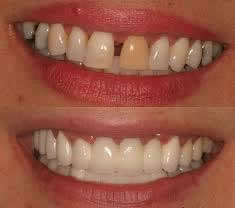 Cosmetic Dentistry prodedure