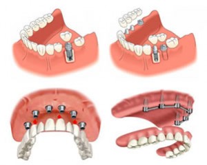 Dental Implan_planstint