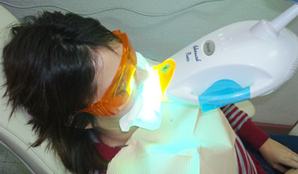 Dental_Bleaching