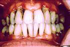 Periodontitis