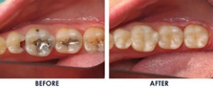 composite_fillings-Cosmetic Dentistry