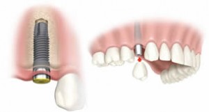 dental-implant-beverly-hills