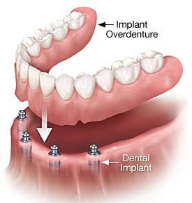 overdenture