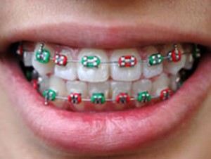 braces orthodontia1