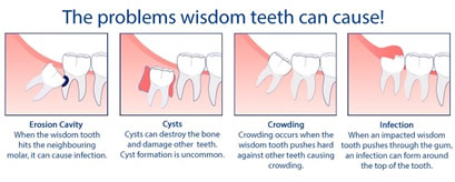 wisdom-teeth