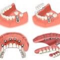 Dental Implant