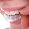 Bleaching and Tooth whitening