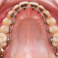 braces orthodontia