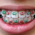 braces orthodontia