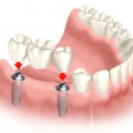 bridge implants