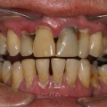 Tobacco Damage Teeth